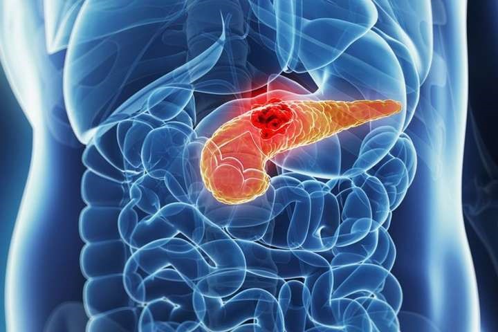 Ученые создали новый метод лечения рака поджелудочной железы