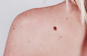Родинки могут оказаться незаметным симптомом рака кожи