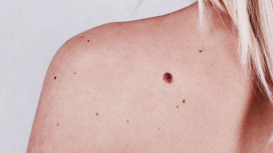 Родинки могут оказаться незаметным симптомом рака кожи