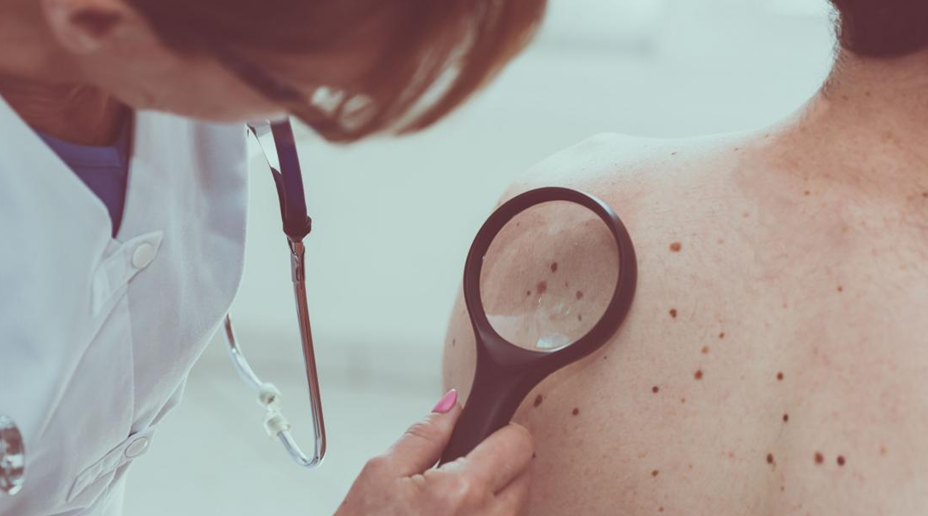 Британские ученые рассказали о признаках, которые могут указывать на развитие рака кожи